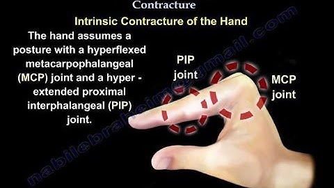 Intrinsic Plus Hand Contracture - Everything You Need To Know - Dr. Nabil Ebraheim