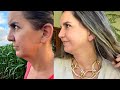 MINHA CIRURGIA ???? 20 DIAS - ANTES E DEPOIS ????TUDO QUE ACONTECEU QUE NÃO CONTEI ???? Foi MUITO D