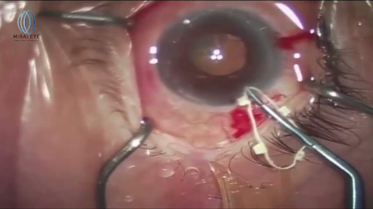 Surgical Instruments – Mirai Eye Inc.
