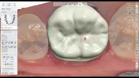 [치과&치과기공실] (3shape) 트리오스 모델리스 사전프랩 46번 싱글 크라운 제작.