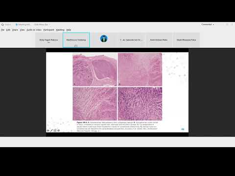 Video: Spliceosome, Potensi Tumit Achilles Tumor Yang Didorong Oleh MYC