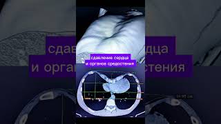 Лечение Тяжёлой Воронкообразной Деформации Грудной Клетки У Парней Старше 15 Лет