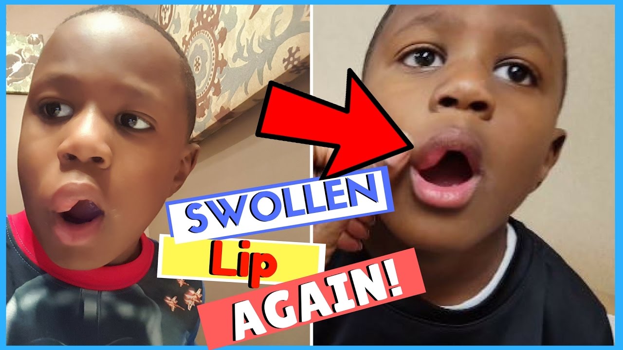 Causes Of Swollen Lips In Toddlers