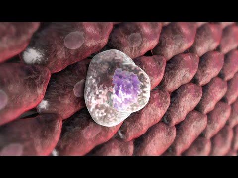 Video: Unterschied Zwischen Atherom Und Atherosklerose