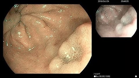 Gastric Cancer with i-scan SE and i-scan OE - Prof. Michida (Case2)