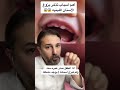 تأخر بزوغ الأسنان عند الأطفال الاسباب جزء 1 التكمله في الفيدهات اللاحقه 