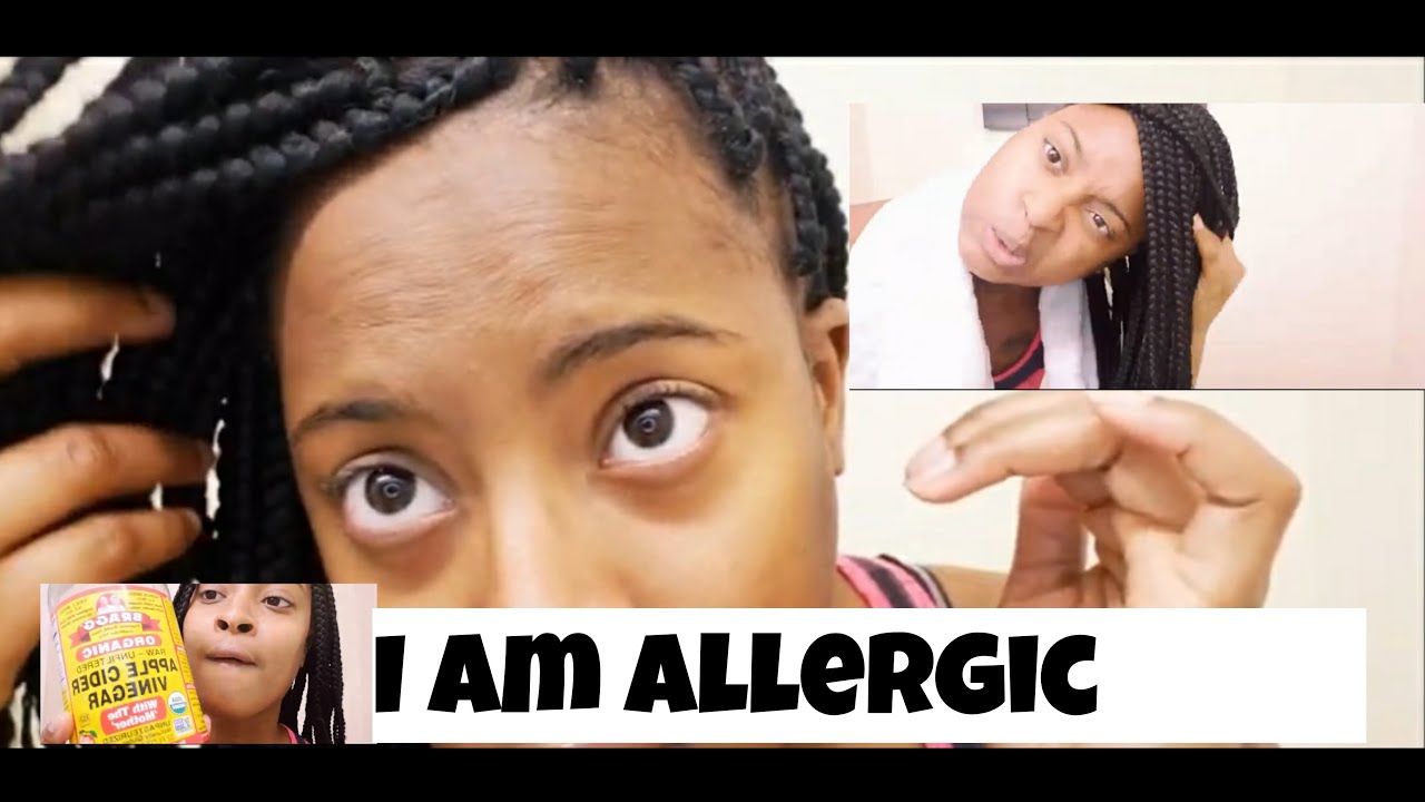 How to Relieve Itchy Scalp With Box Braids + ALLERGIC REACTION😩 YouTube