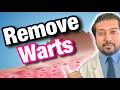 Wart Removal 101 | How to Get Rid of Warts FOR GOOD | Warts Treatment