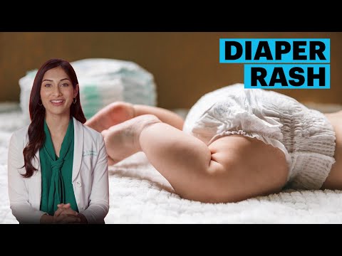 Diaper Rash Symptoms and Remedies | The Parents Guide | Parents thumbnail