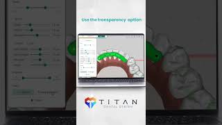 Learn how to use blockouts in Titan Dental Design !!! 🦷💻 #aligners #dentist #orthodontics #tutorial screenshot 2