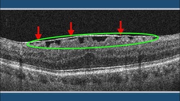 Epiretinal Membrane (ERM)