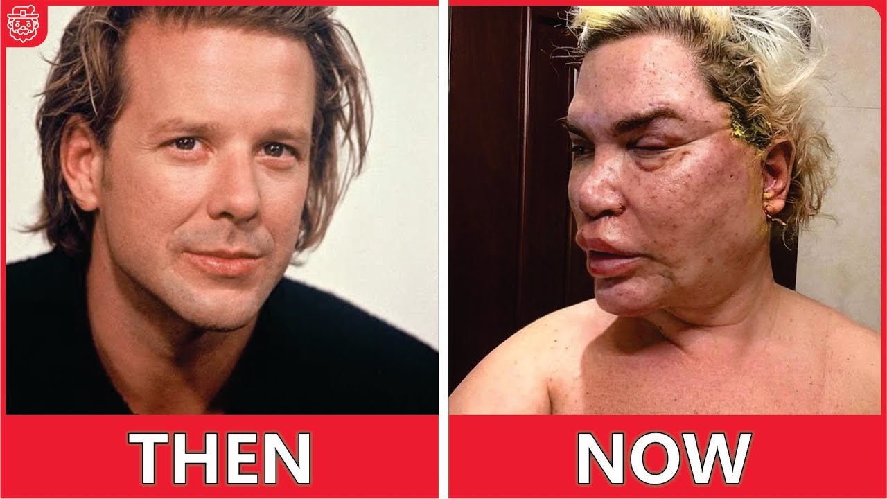 20 Famous Faces Ruined by Surgery | Then and now 2025