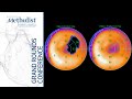 ISCHEMIA Trial–Implications for Coronary CTA & Myocardial Perfusion Imaging (D. Berman, MD) 10/08/20