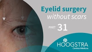 Eyelid surgery without scars - Part 31