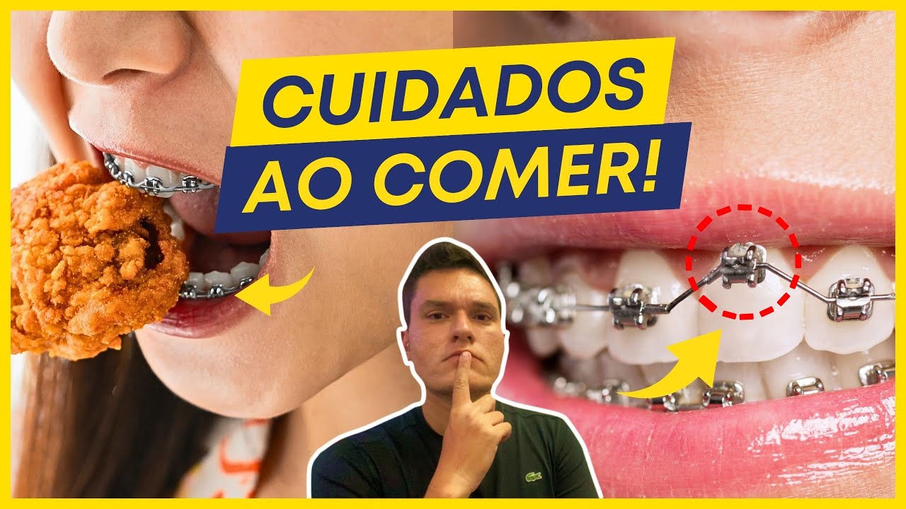 7 CUIDADOS ESSENCIAIS AO COMER COM APARELHO ORTODÔNTICO! - YouTube