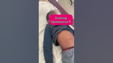 Generalised Tetanus. RISUS SARDONICUS. Opisthotonos