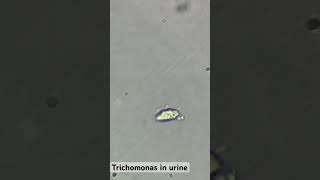 Trichomonas (Trich) in urine!