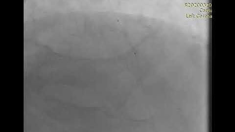 PCI to CTO LAD using microcatheter assisted antegrade wire escalation (case 2)