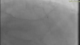 PCI to CTO LAD using microcatheter assisted antegrade wire escalation (case 2)