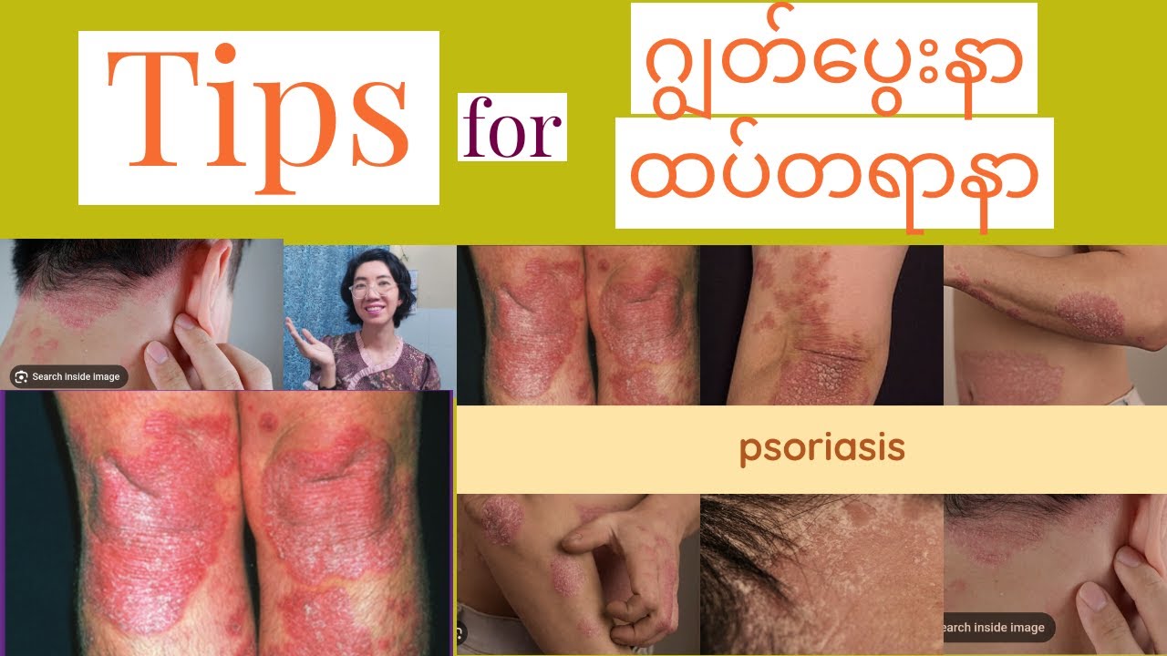 Dermatologist's tips for psoriasis ဂျွတ်ပွေးနာ စိုရိုင်ရေးစစ်လူနာများအတွက်အသုံးဝင်မဲ့အရာများ