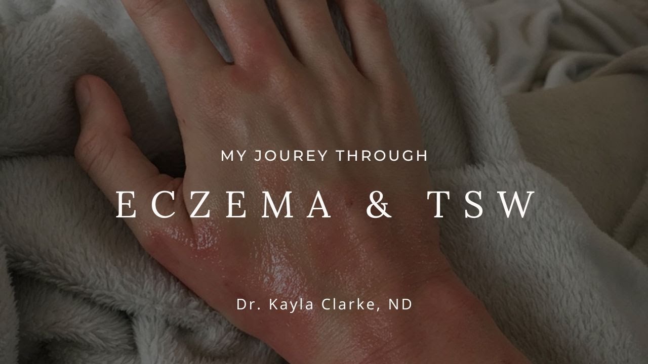 My TSW & Eczema Story YouTube