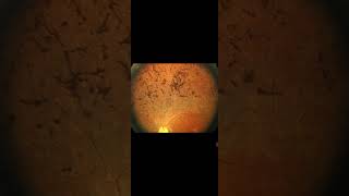 Retinitis Pigmentosa in Eye 👁‍🗨 (Retinal degeneration)Genetic disease Awerenes of All  Opthalamology