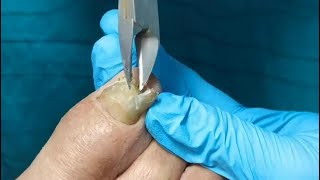 A thick and yellow toe nail was cut off from toe. Fungal nail treatment &amp; ingrown toenails removal.