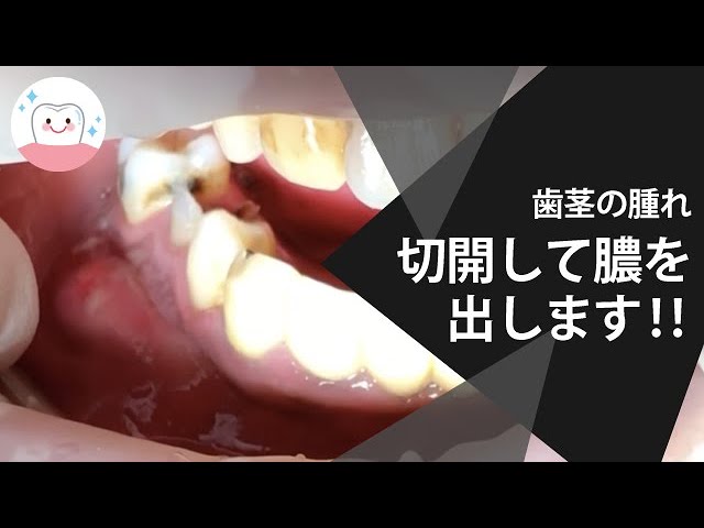 ぶよぶよの歯茎の膿を取り除く Gum Swelling Due To Periodontal Disease Youtube