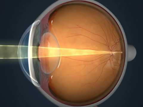 Khái niệm cơ bản về mắt: CHÍNH THỊ & TẬT KHÚC XẠ