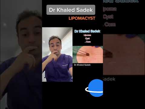 Massive Blackhead extraction
