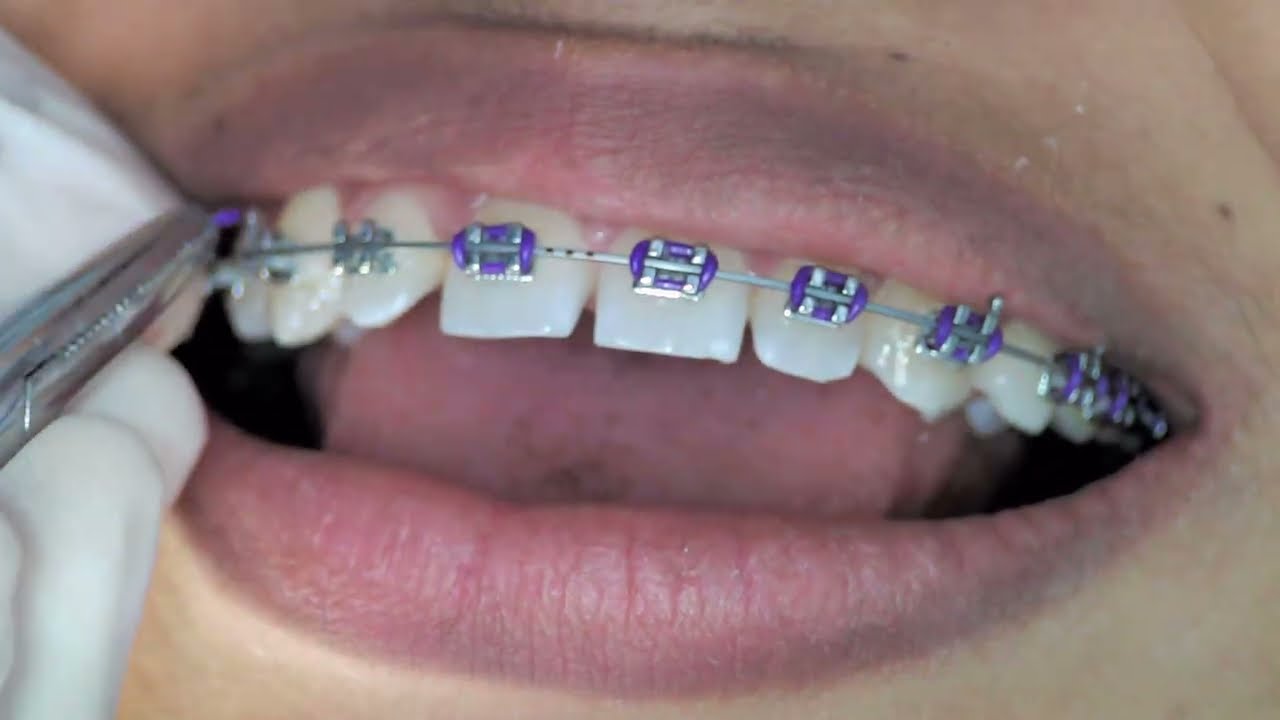 Ajuste de Brackets, Que se tiene en cuenta?🦷