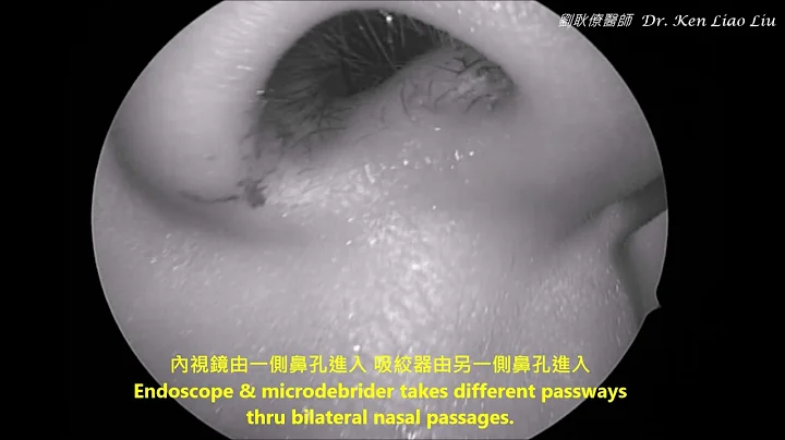 小兒長期鼻塞：腺樣體肥大 endoscopic microdebrider-assisted adenoidectomy - 天天要聞
