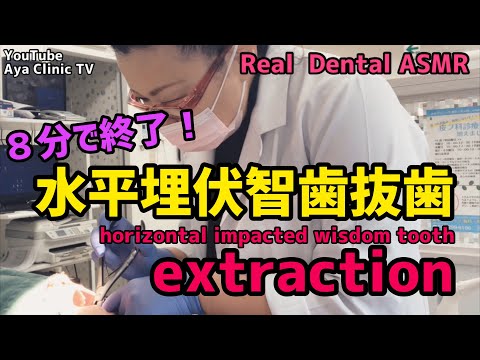 Real Dental ASMR "Extraction of wisdom tooth" リアル歯医者ASMR「8分で終了！水平埋伏智歯の抜歯」