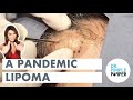 A Pandemic Lipoma