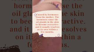 Cradle cap in babies|#youtubeshort #shortsfeed #trending #baby #babyhealth #babycare #trend #shorts