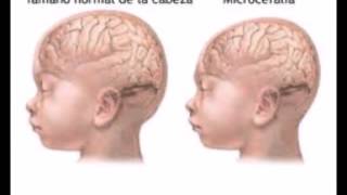 Zika en embarazadas crea malformacion en bebes (microcefalia)