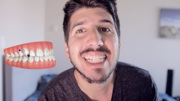 My invisalign experience - cost, prep and results