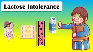 Lactose Intolerance - Types, Causes, Pathophysiology, Signs &amp; Symptoms, And Treatment