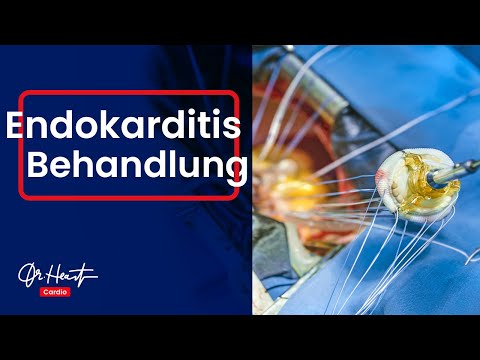 Video: Wo findet sich eine Endokarditis im Körper?