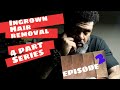 Ingrown Hair Removal | 4 Part series | #Episode 2 |