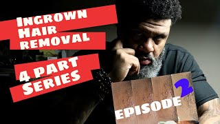 Ingrown Hair Removal | 4 Part series | #Episode 2 |