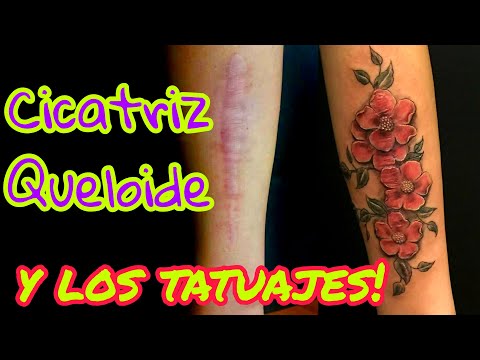 Vídeo: Tatuaje Queloide: Cuando Se Forman Cicatrices, Tatuajes Sobre Queloides, Más