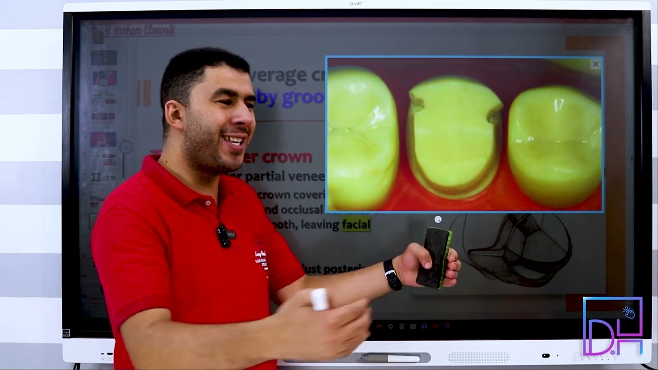 10- Crowns Classifications (Partial Coverage) P1