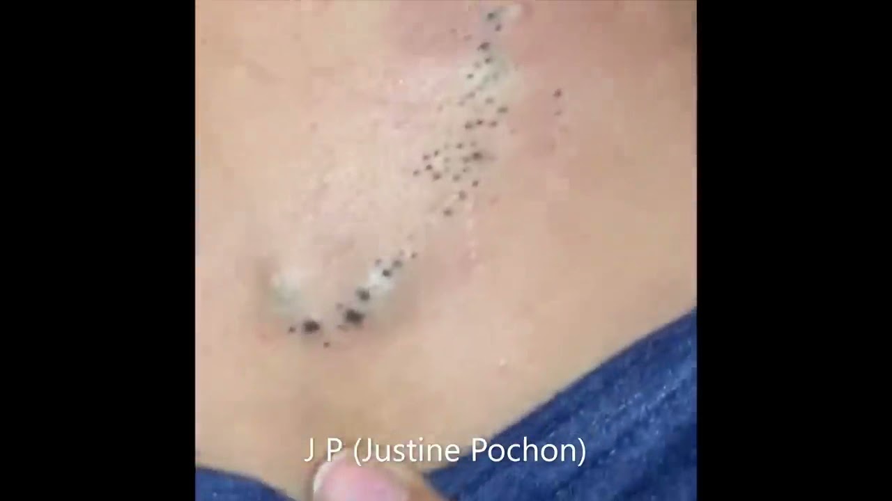 Normes points noirs zone sous cutane infecte  huge blackheads infected skin Justine Pochon
