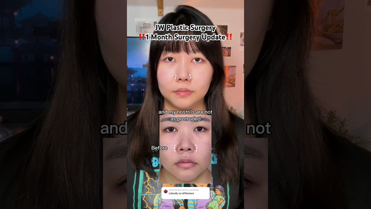 The difference is amazing 😳 1 month surgery comparison! @JwbeautyNetKorea #jwplasticsurgery