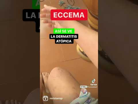 Video: 3 formas de lidiar con el eccema del pezón