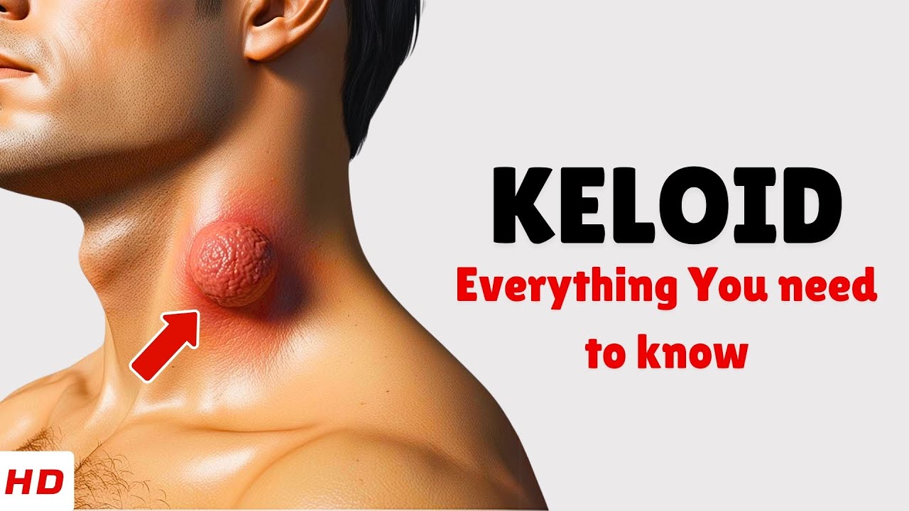 Keloid – Causes, Signs and Symptoms, Diagnosis & Treatment
