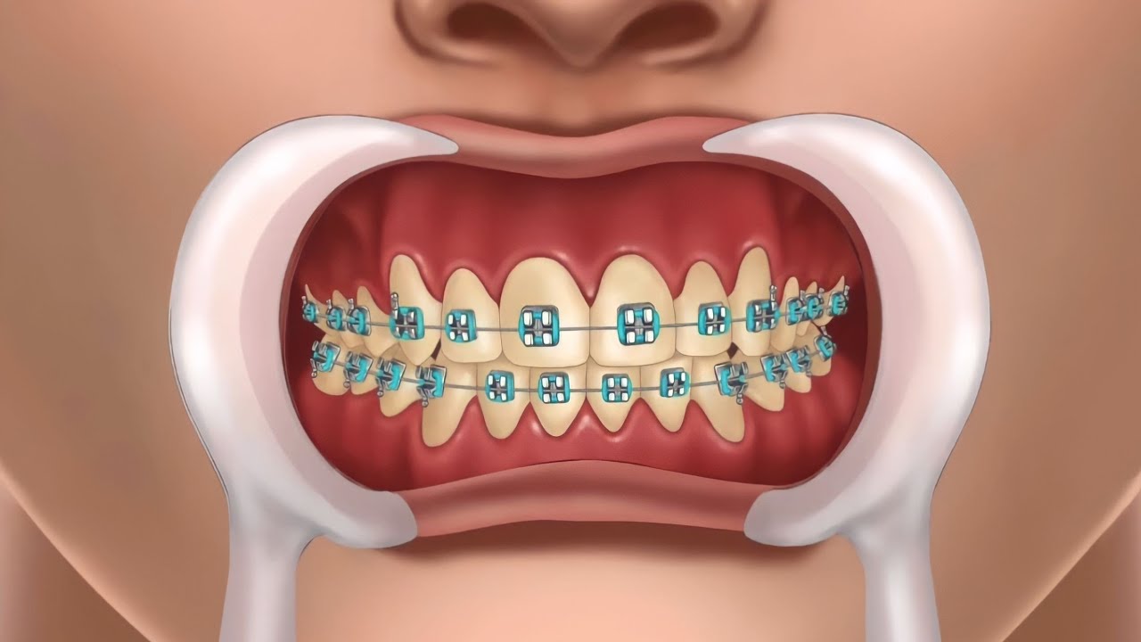 Asmr Tooth ASMR Tooth Treatment - YouTube