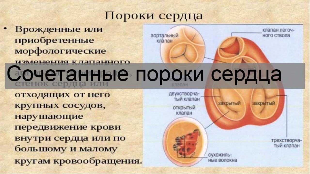 Сочетанные пороки сердца