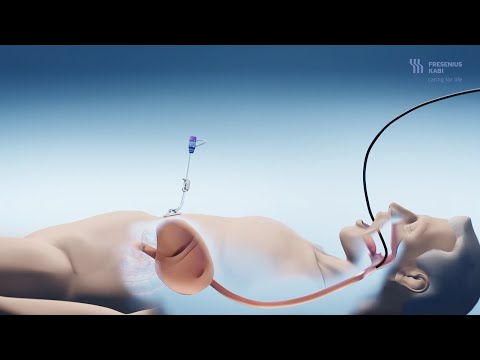 Video: Ist eine Gastrostomiesonde sicher?